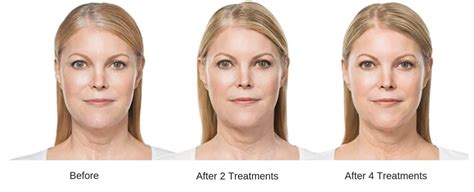 KYBELLA® in Reno, NV 